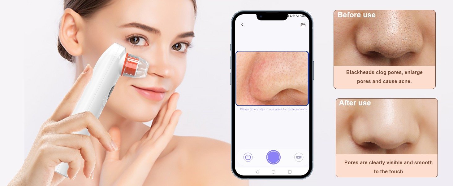 Blackhead Remover